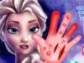 Frozen. Hand surgery